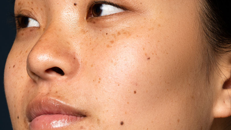 Koreaanse huidverzorging voor de vette huid